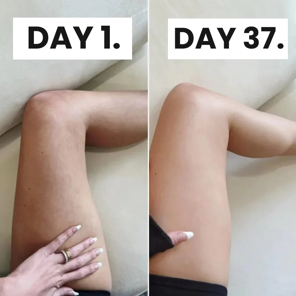 Cupping-massageapparaat tegen cellulitis